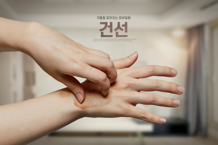 서대문구엑시머 건선치료 증상 심해지기전에 받으세요 관련 이미지 4