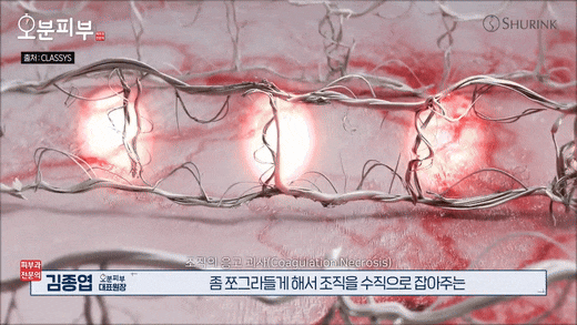 Bukahyeon-dong Dermatology Clinic: Ultherapy Effects, Side Effects, Pain, and Duration <Complete Guide> image 4