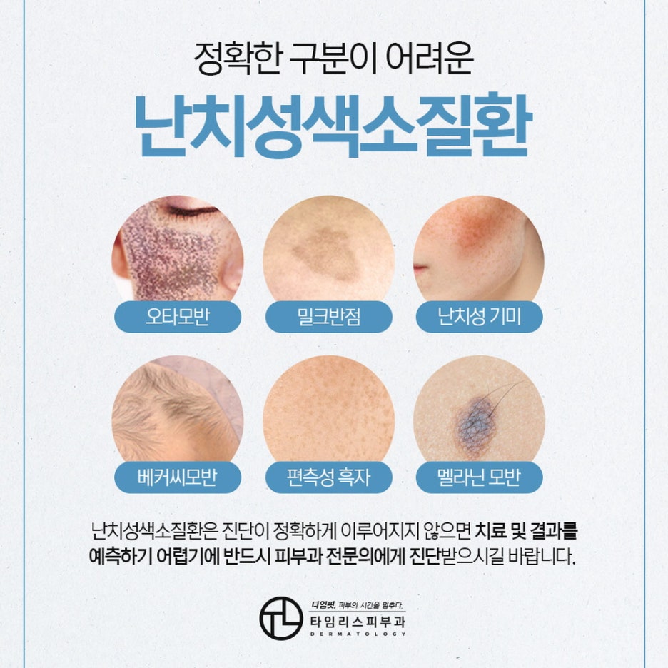 난치성색소치료잘하는곳 얼룩진 반점 고민을 덜어내 관련 이미지 2