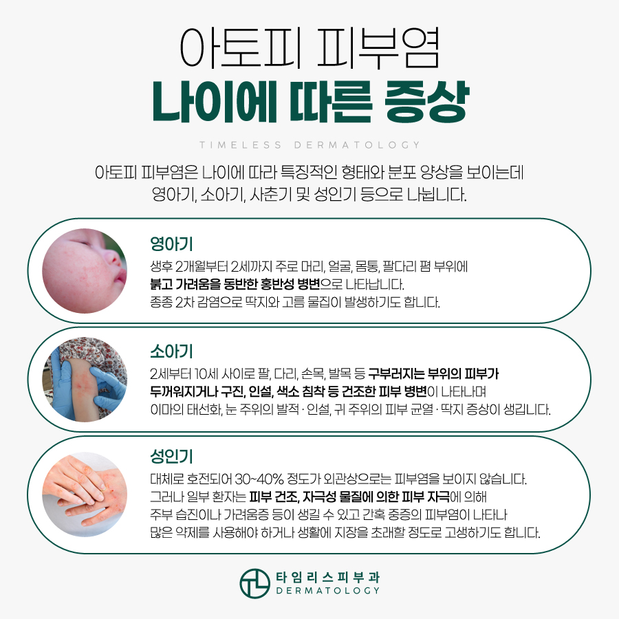 아토피피부염 맞춤 치료를 위해 원인부터 알아야 관련 이미지 3