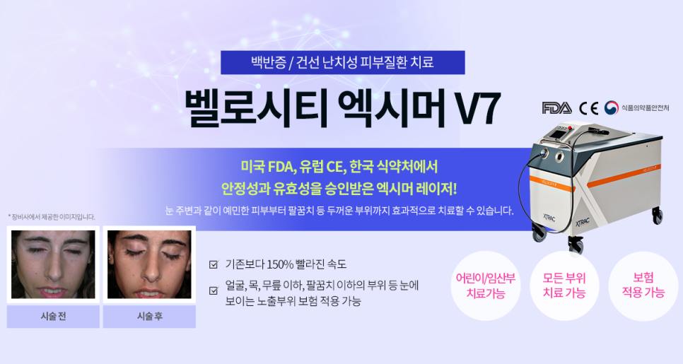 마포/아현 엑시머 백반증과 건선 치료해요 관련 이미지 4