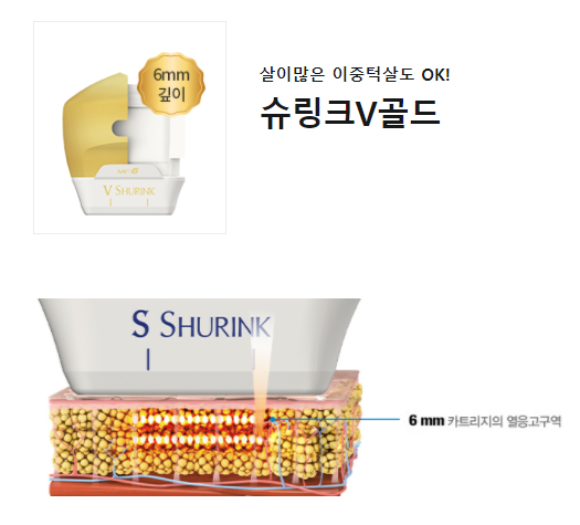 이대역피부과 턱살관리 살이 많은곳에 골드 슈링크리프팅 타임리스 관련 이미지 4
