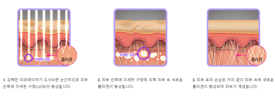 여드름흉터 없애는법 레이저 확인해보세요 관련 이미지 6
