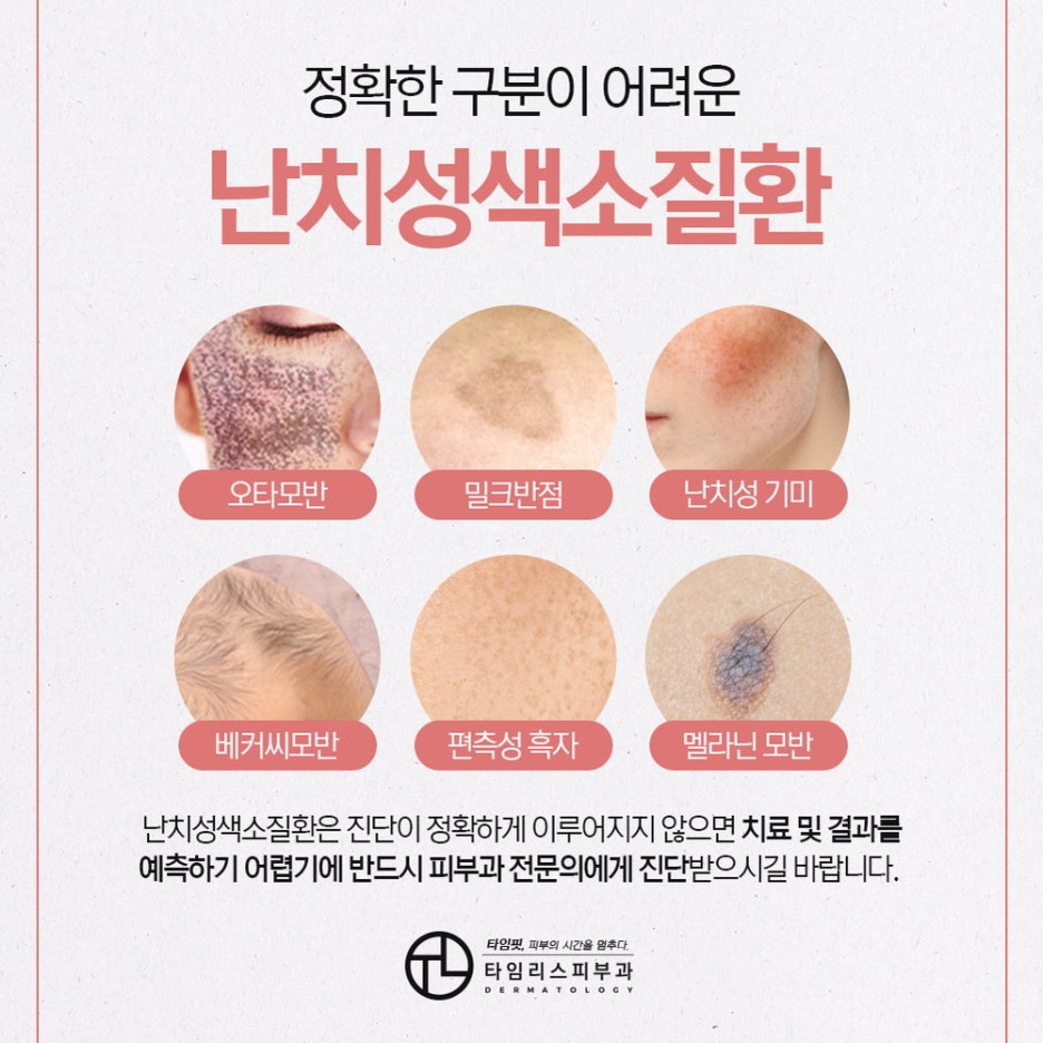 염리동피부과 까다로운 색소질환, 바르게 개선하려면 관련 이미지 2