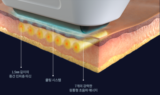 A Dermatology Specialist at Ewha Explains the Difference Between Thermage and Sofwave image 3