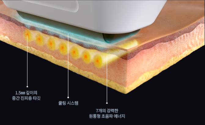홍대 소프웨이브 볼패임 걱정 없는 탄력관리 관련 이미지 3