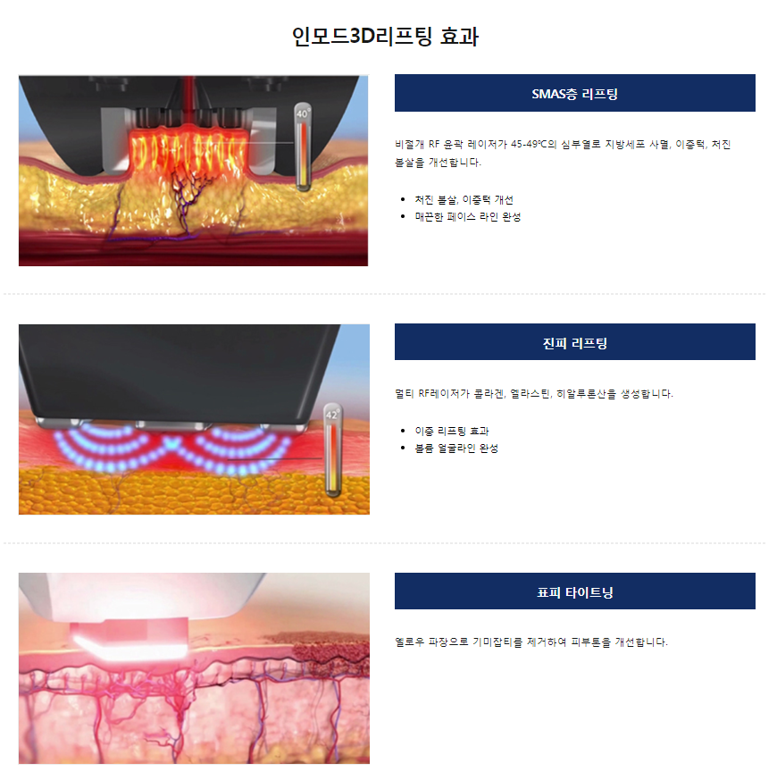 마포리프팅 날렵한 턱선이 부럽다면 타임리스에서 인모드리프팅 관련 이미지 4