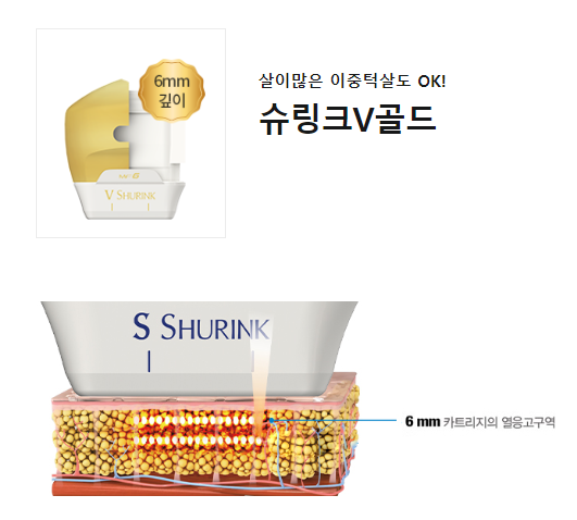 이대피부과 이중턱 타임리스 골드슈링크리프팅으로 당기기 관련 이미지 5