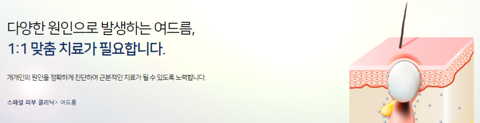 북아현동피부과 여드름치료 타임리스로오세요 관련 이미지 2