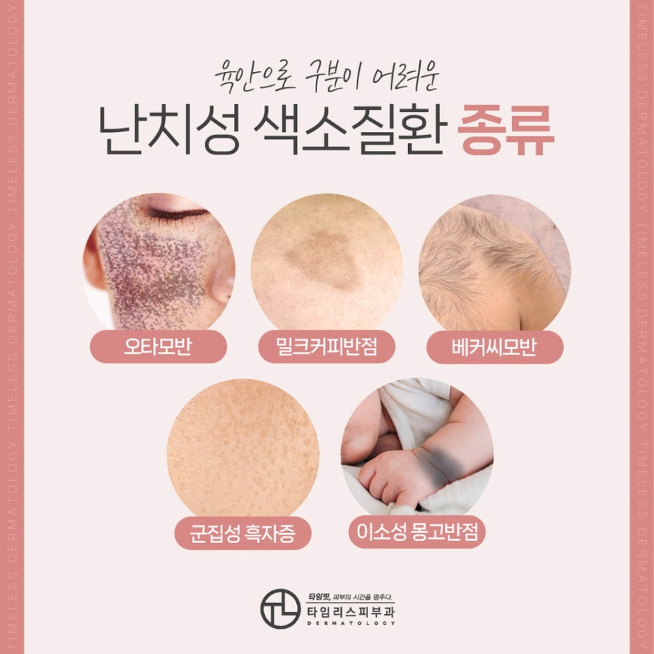 색소치료를 통해 깨끗한 피부 자신감 관련 이미지 4