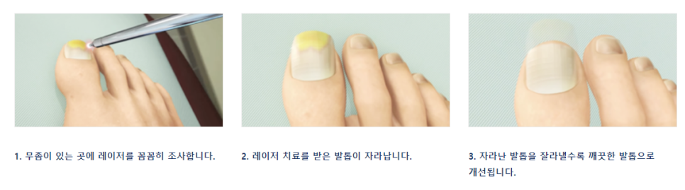 무좀증상 구강청결제 식초 민간요법 사용해도 되는걸까? 관련 이미지 6