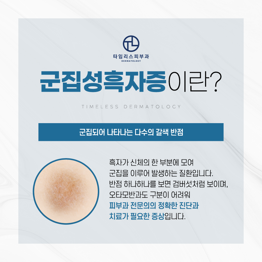 군집성흑자증 마포피부과에서 해결! 관련 이미지 2