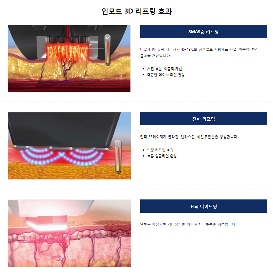 이중턱리프팅 턱살 신경쓰인다면 인모드리프팅 관련 이미지 5