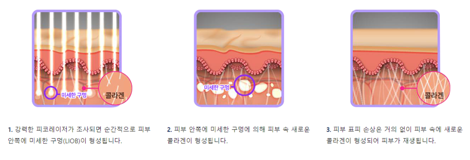 공덕피부과 피코 플러스 흉터 오타모반 고민은 타임리스에서 관련 이미지 4