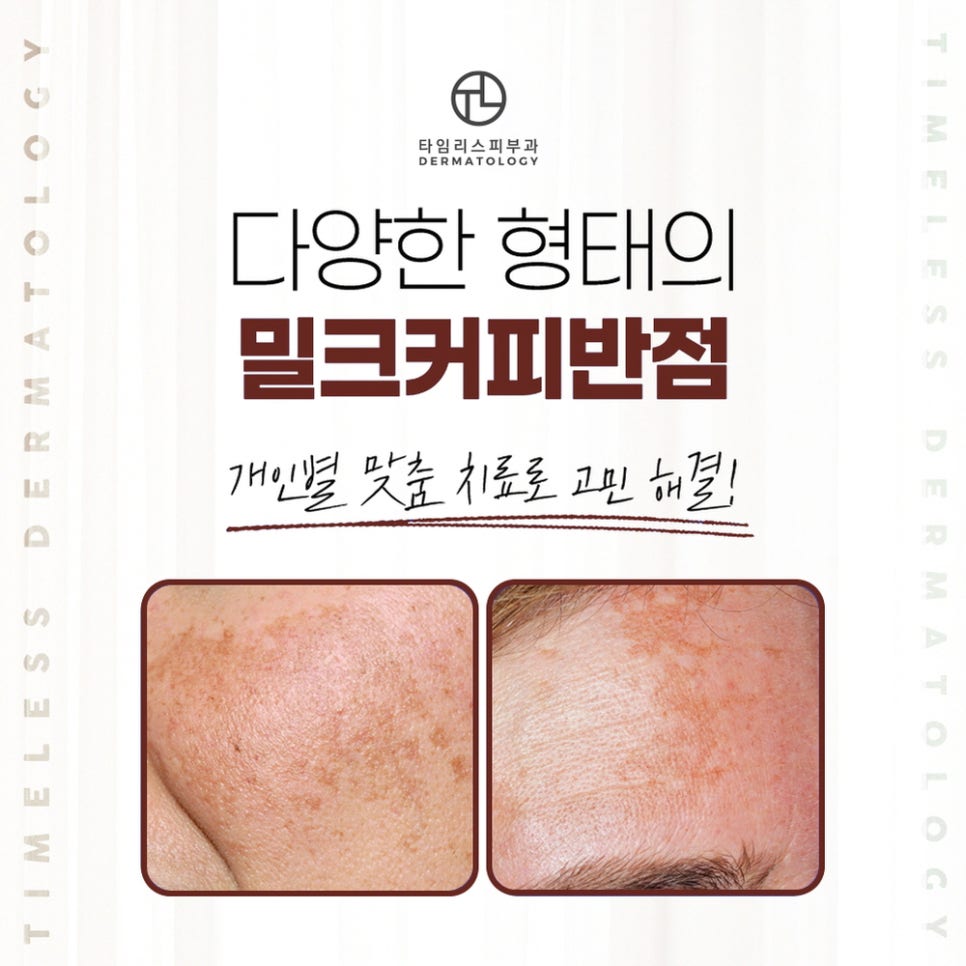 피부반점으로 상처받는 일은 이제 그만! 관련 이미지 3
