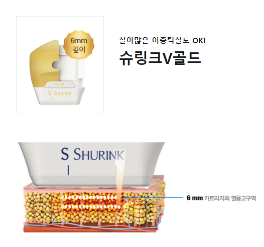 팔자주름없애기 슈링크리프팅효과 확인하세요 관련 이미지 4