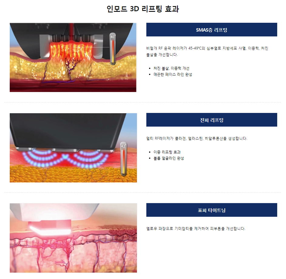 인모드리프팅후기 이중턱 고민이라면 꼭 확인하세요 관련 이미지 5