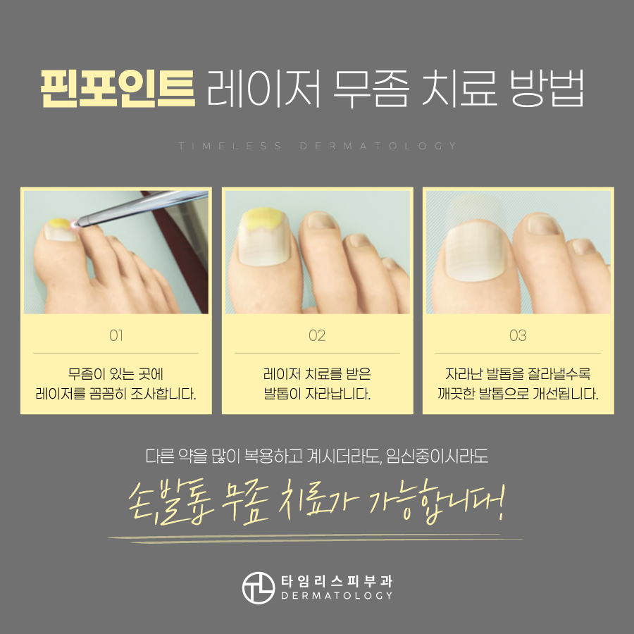 발톱무좀치료병원 핀포인트레이저 통한 빠른 치료를 관련 이미지 4