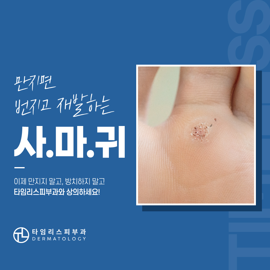 마포사마귀 레이저 치료 가능할까 관련 이미지 2