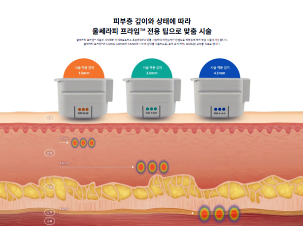 종로 울쎄라 고민할 때 가장 많이 묻는 질문 관련 이미지 3