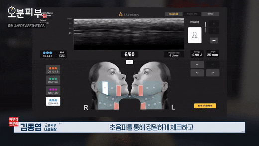 Dermatology Clinic Near Mapo Station: Ultherapy Effects, Side Effects, and Duration <Complete Overview> image 3