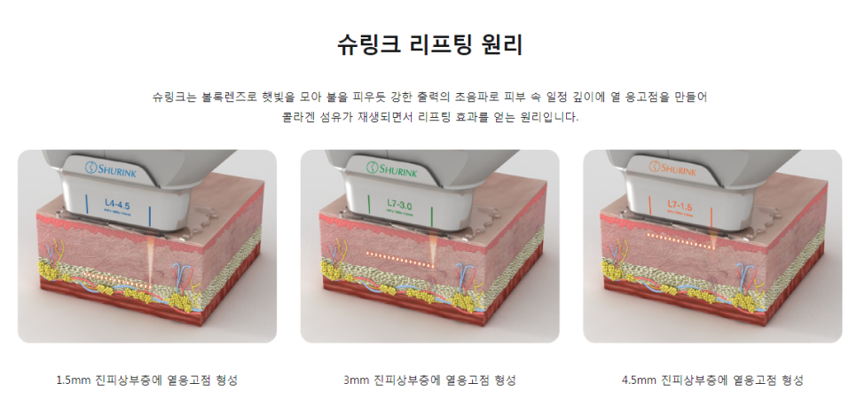 마포슈링크리프팅 웃을때마다 생기는 눈가주름 타임리스로 관련 이미지 5