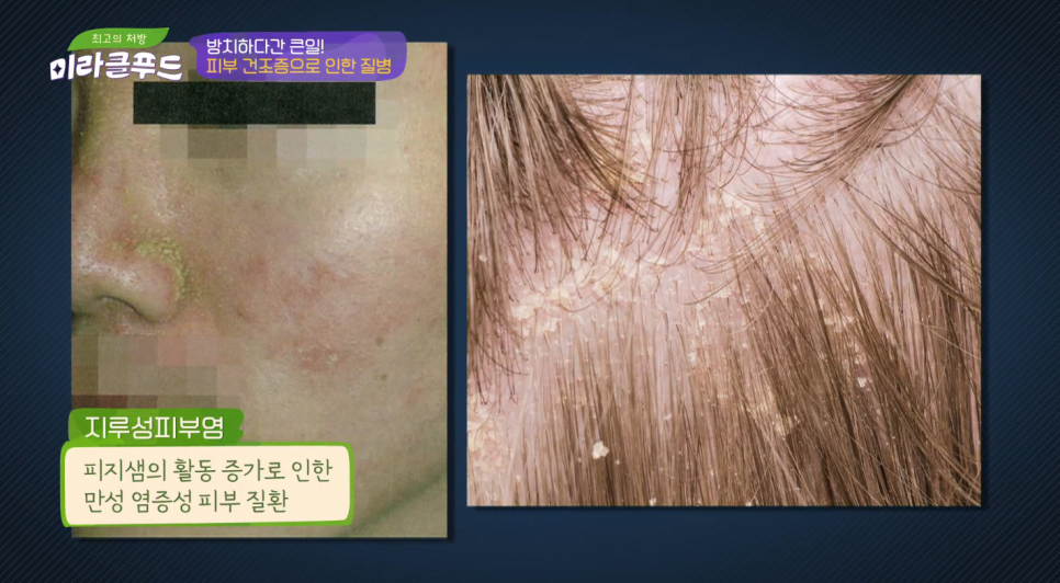 타임리스피부과 마포본점 김종엽 원장님 JTBC 미라클푸드 출연 관련 이미지 5