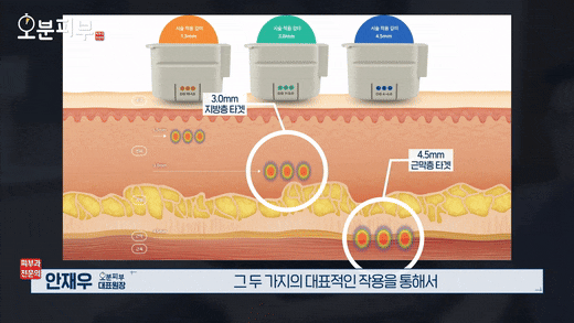 애오개역피부과, 울쎄라 리프팅 볼패임? 걱정된다면 관련 이미지 6
