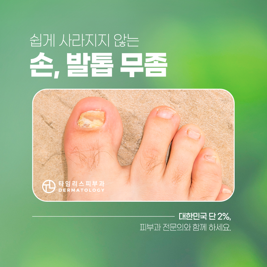 홍대손발톱무좀 쉽게 사라지지 않는다면 관련 이미지 1
