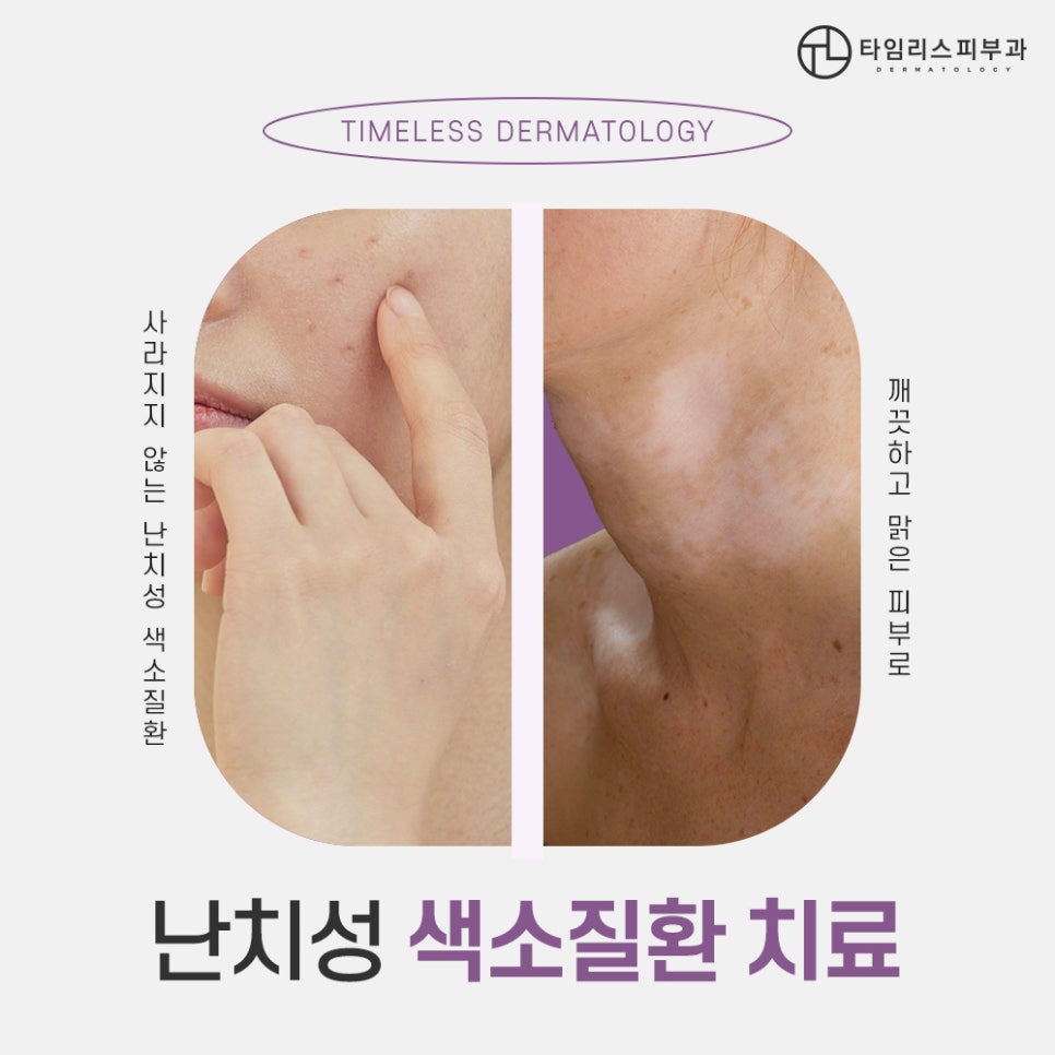 마포피부과전문의 색소질환 정밀한 진단 필요해! 관련 이미지 1