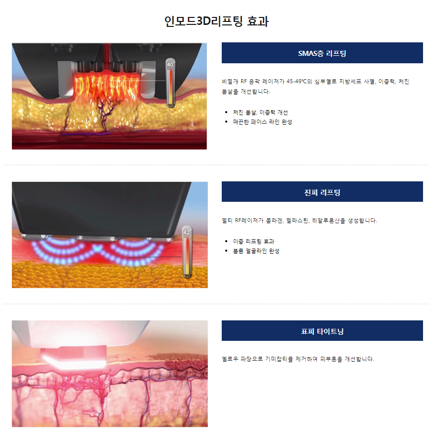 리프팅추천 세번당겨주는 인모드리프팅이라고 아시나요? 관련 이미지 5
