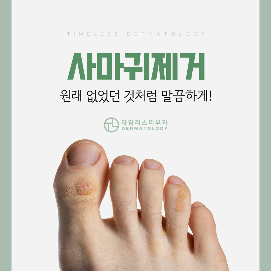 마포사마귀 레이저 치료 가능할까 관련 이미지 1