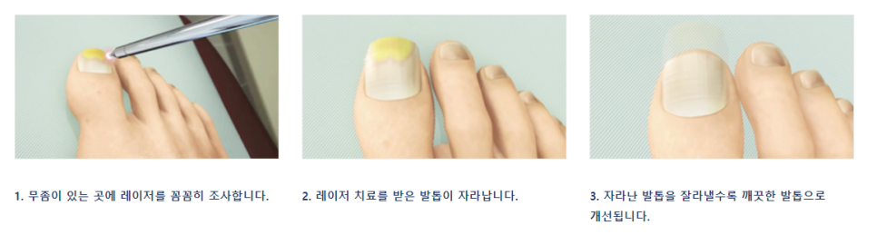 공덕피부과 무좀치료비용 실비보험 핀포인트레이저 타임리스에서 관련 이미지 5