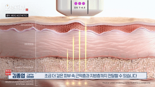 Written by a Dermatology Specialist in Seodaemun-gu: Ultherapy vs. Thermage Effects <Complete Summary> image 4