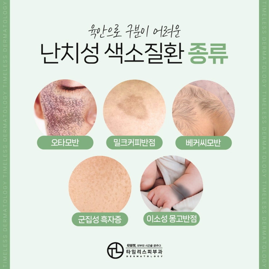 서대문구기미치료 전문의 진단으로 건강하게 관련 이미지 4