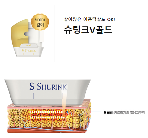 이중턱없애기 슈링크리프팅효과 어떨까? 관련 이미지 3