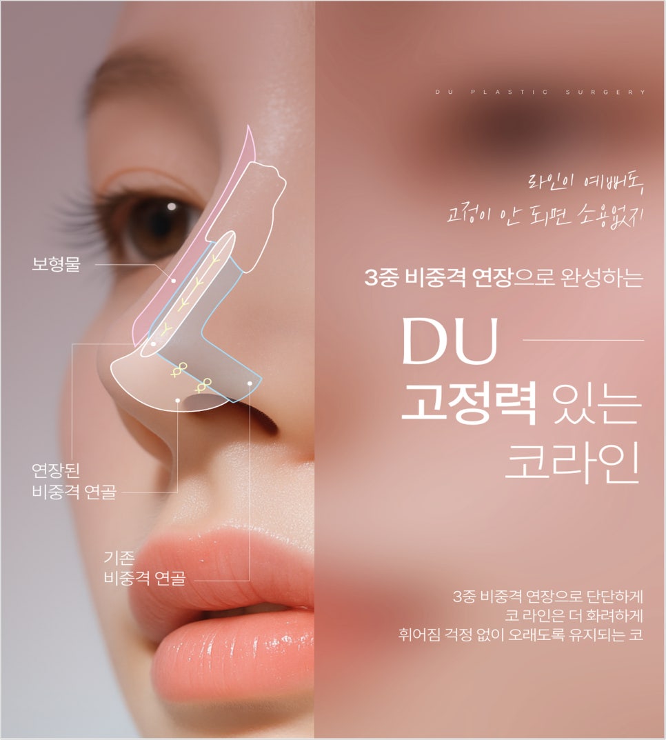 Nose Filler Migration: What You Must Know If You’re Considering Nose Surgery image 7