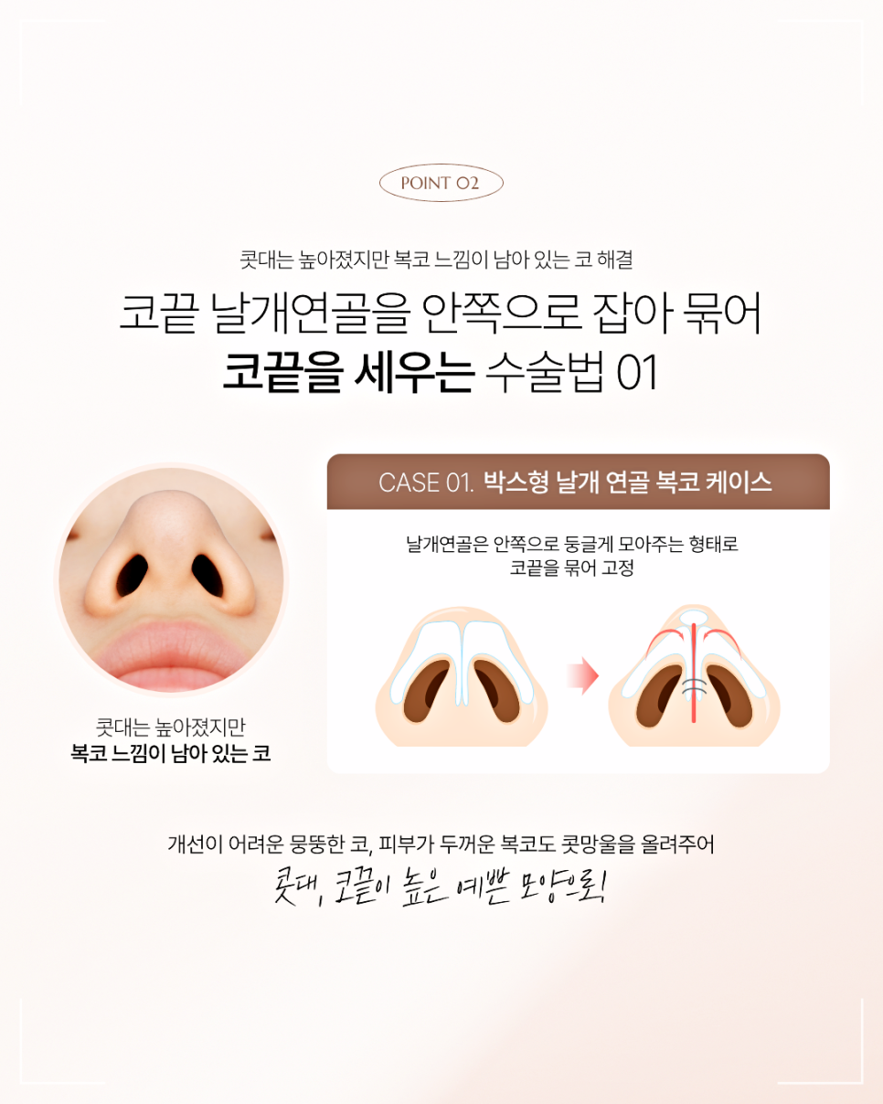 짧은코 재수술, 해결하려면 구조부터 봐야 합니다 관련 이미지 6