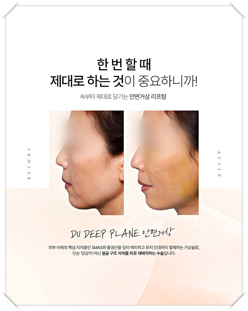 미니거상흉터 최소화, 자연스러운 리프팅을 위한 전략 관련 이미지 12