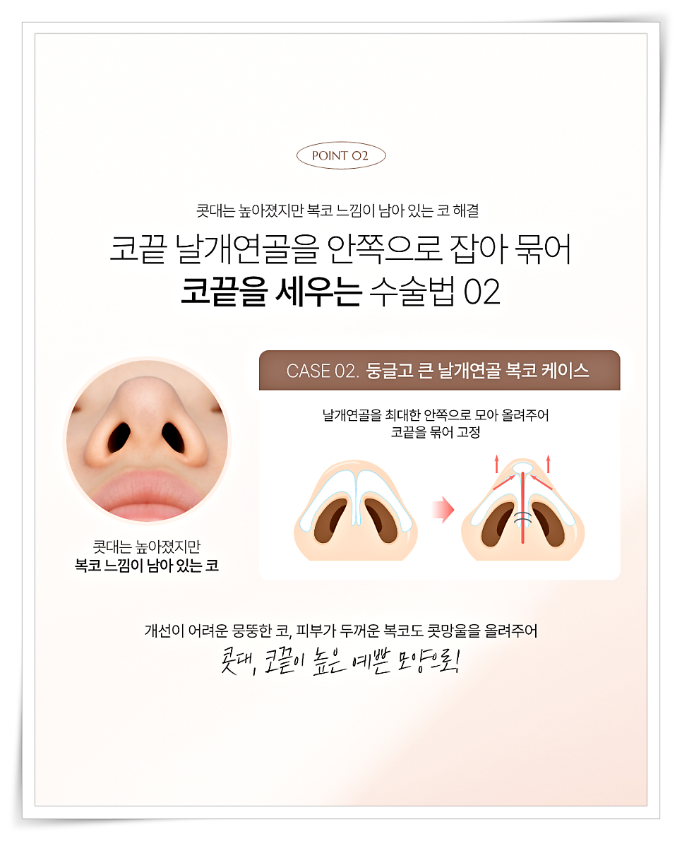 A Design Method to Avoid Failure in Short Nose Revision Surgery image 4