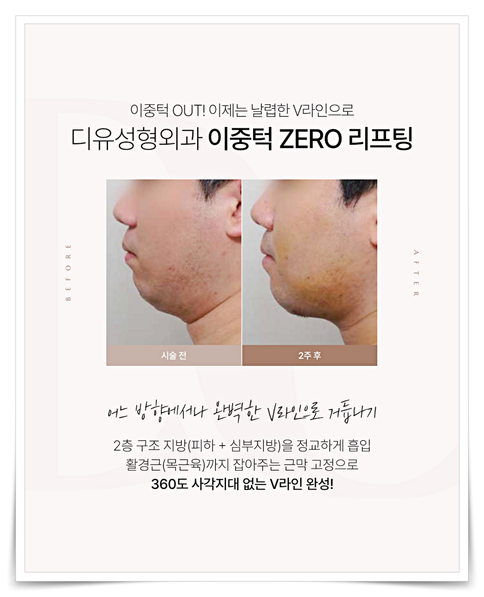 Double Chin Removal Surgery: How to Get Rid of a Double Chin Completely image 9