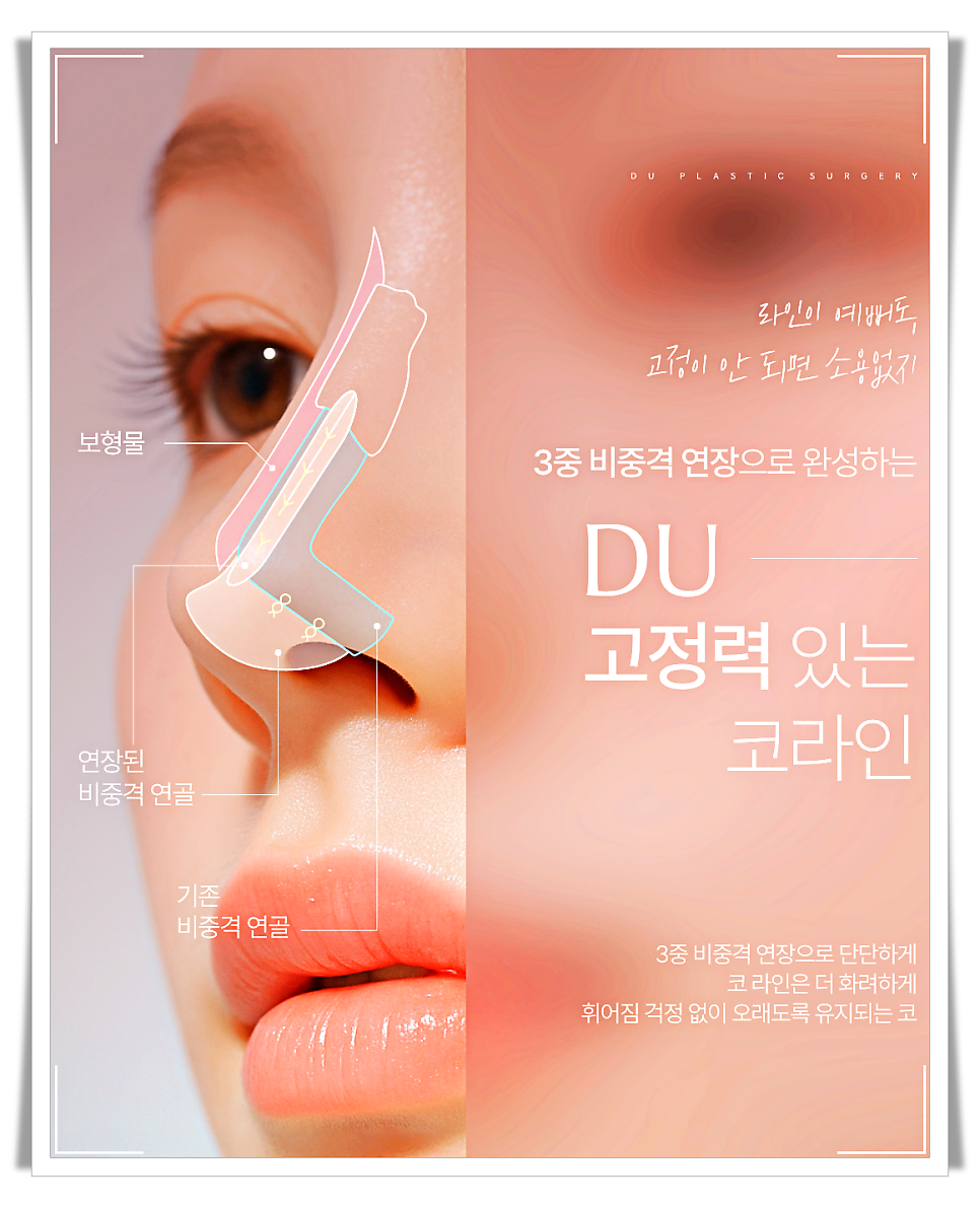 코끝처짐 원인과 교정 방법 관련 이미지 11
