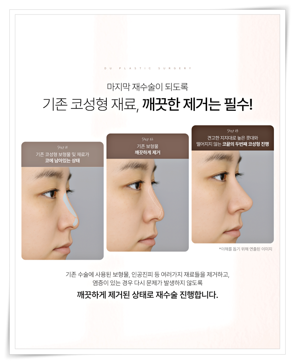 A Design Method to Avoid Failure in Short Nose Revision Surgery image 12