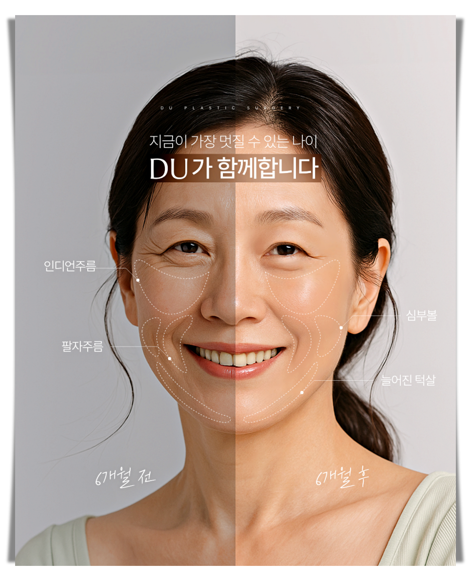 A More Certain Choice Than Mini Thread Lifting: Mini Facelift image 9