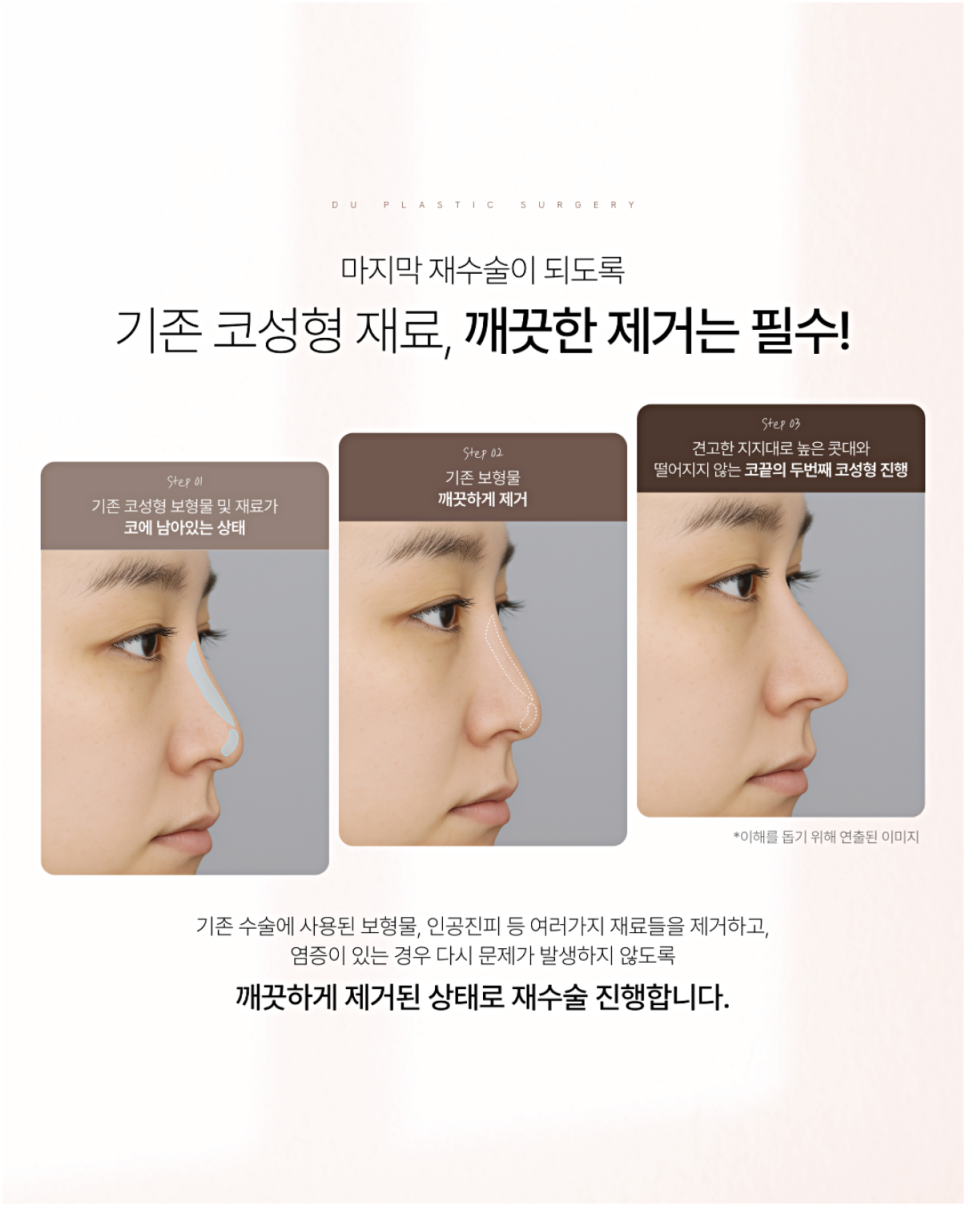 매부리코재수술 더 신중하게 결정해야 하는 이유 관련 이미지 2