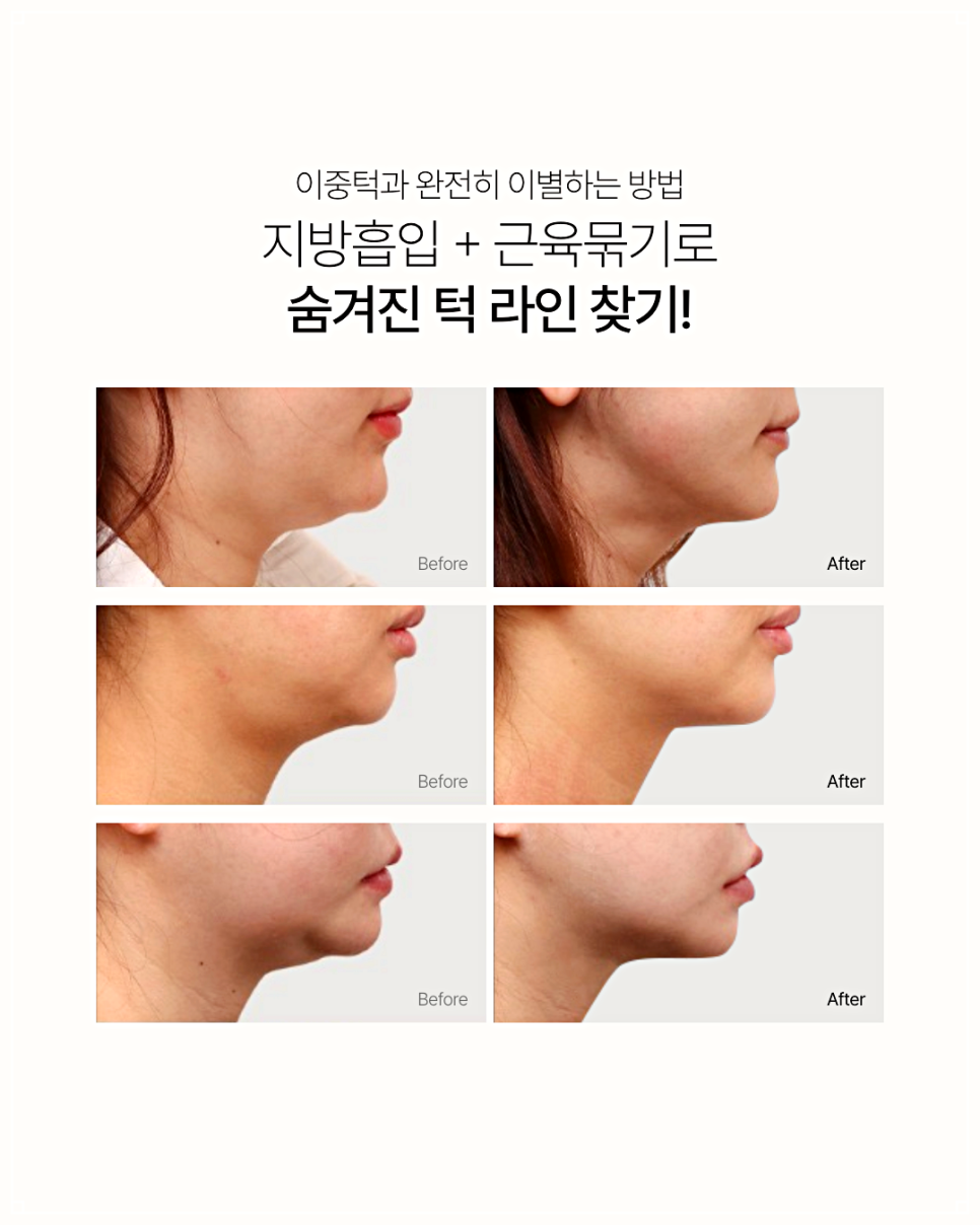 Why Double Chin Botox Is Not a Fundamental Solution image 6