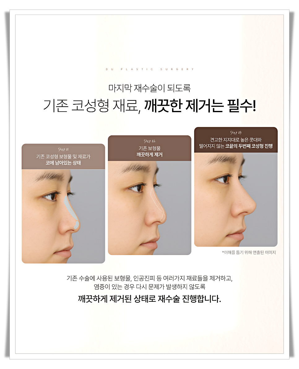 코끝처짐 원인과 교정 방법 관련 이미지 6