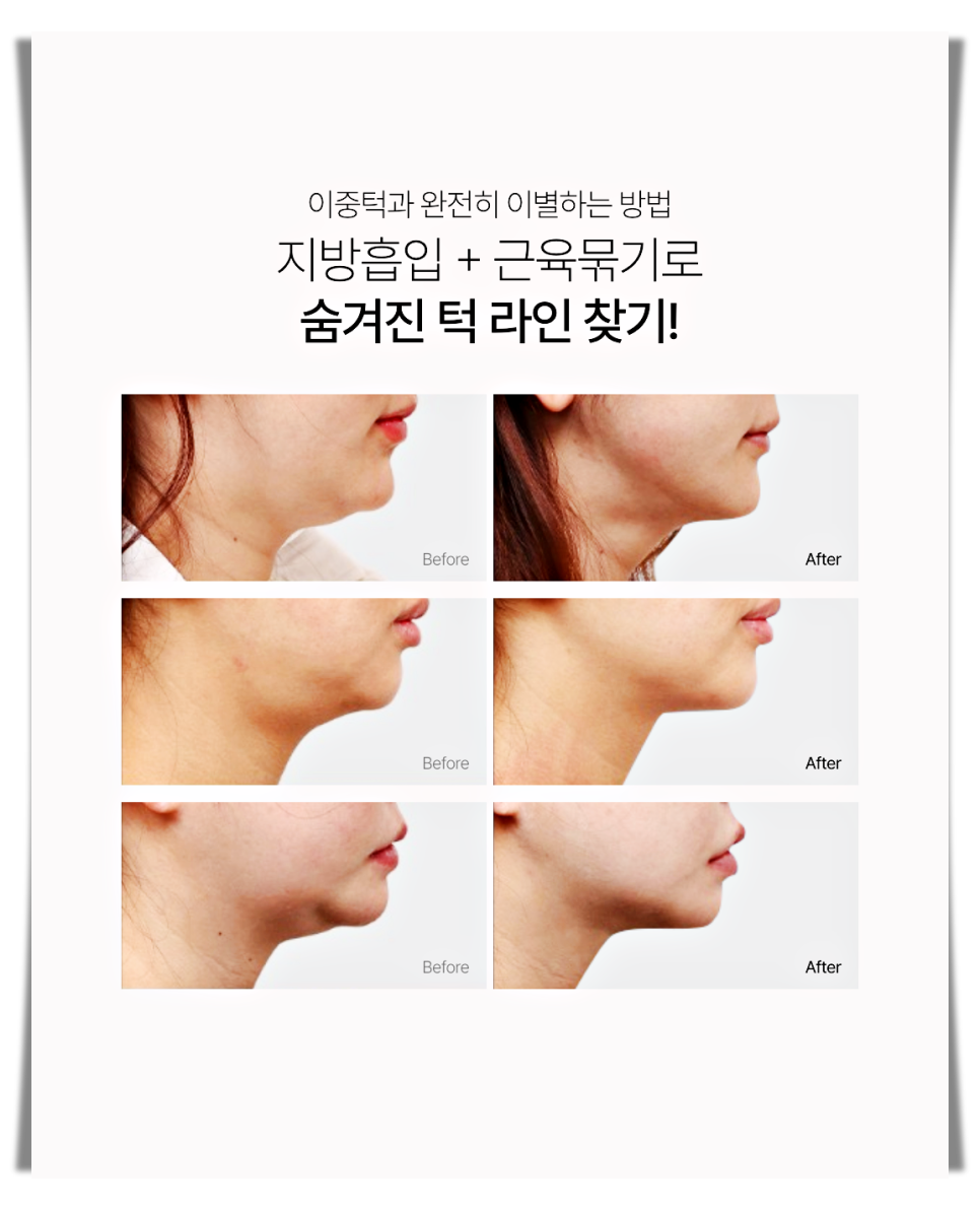 How Can You Get Double Chin Muscle Tightening Safely Without Side Effects? image 4