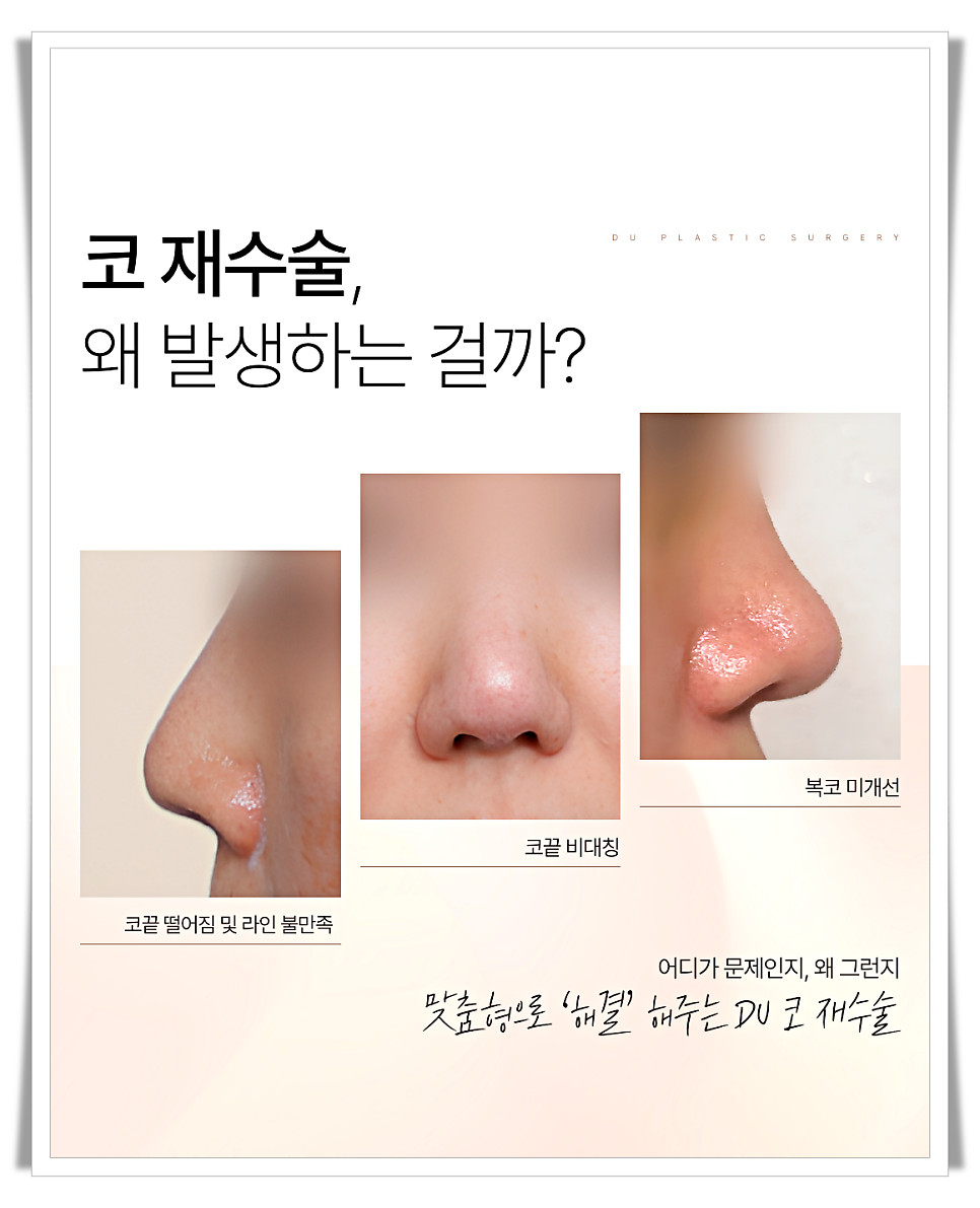 코끝처짐 원인과 교정 방법 관련 이미지 5