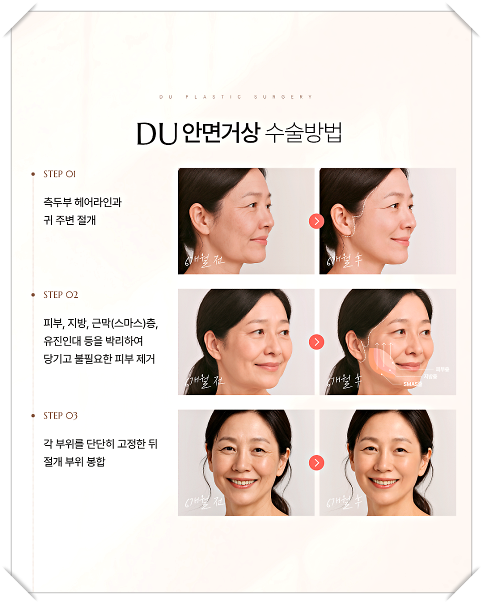 미니거상흉터 최소화, 자연스러운 리프팅을 위한 전략 관련 이미지 9